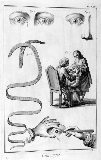 Chirurgia oculare, 1751-1777 da Unbekannt