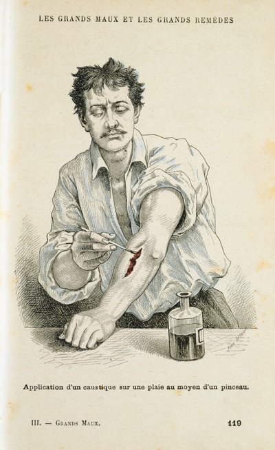 Disinfettare una ferita con una soluzione antisettica, c1890 da Unbekannt