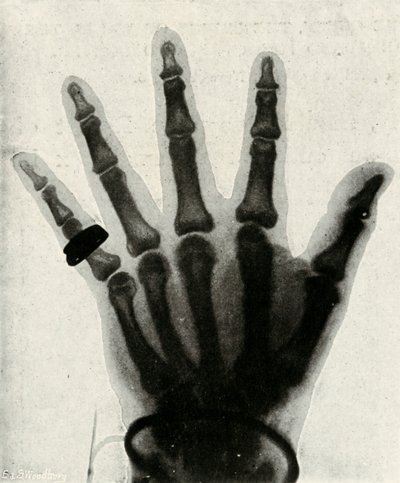 Radiografia della mano di S.A.R. Il Principe di Galles da Unbekannt