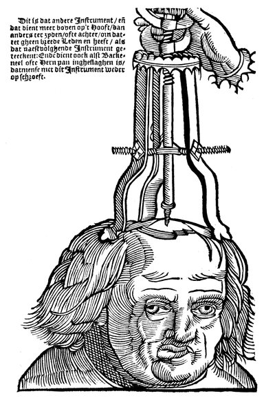 Trapanazione, 1593 da Unbekannt