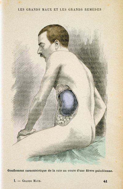 Milza ingrandita tipica di un paziente con malaria, c1890 da Unbekannt