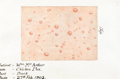 Malattie, Varicella Acquerello della malattia della pelle varicella, 27 febbraio 1902 da Unbekannt