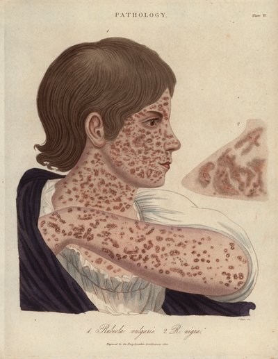 Morbillo e rosolia - Litografia di John Pass, pubblicata in 
