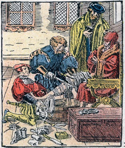 Amputazione di una gamba nel XVI secolo. da Unknown artist