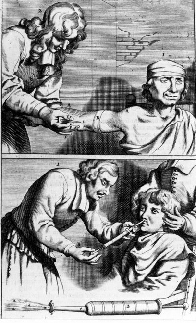 Sanguinamento e doccia nasale di Johannes Sculpteti "Armamentarium Chirurgicum" Amsterdam 1672 da Unknown artist