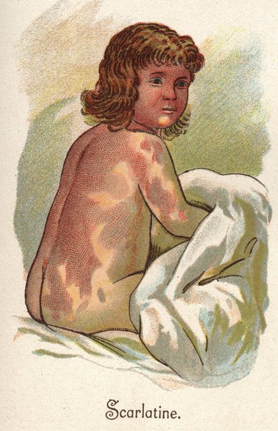 Malattie infantili: Scarlattina. In 
