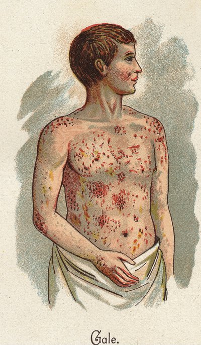 Malattie infantili: La scabbia. In "La nuova medicina naturale" di F.E. Bilz da Unknown artist