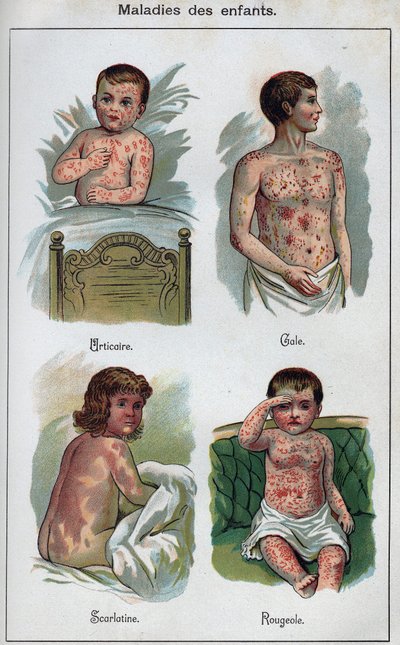 Malattie dei bambini: Orticaria, morbillo, scabbia, scarlattina. In "La nuova medicina naturale" di F.E. Bilz da Unknown artist