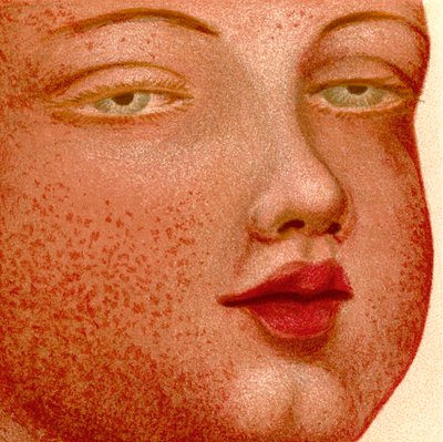 Febbri eruttive: Scarlattina o febbre scarlatta da Unknown artist