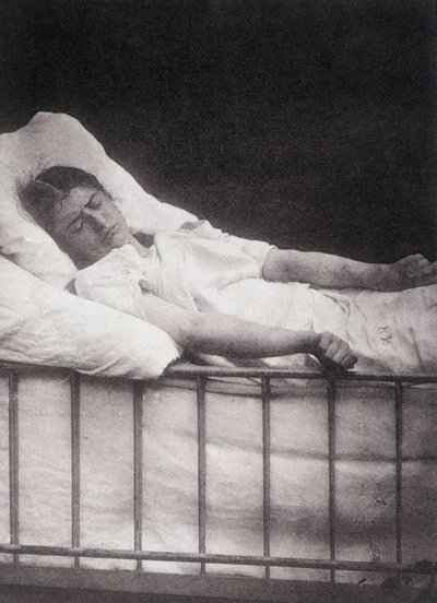 Hystero Epilepsie - Attacco di tetanismo in “Iconografia fotografica della Salpêtrière: servizio del Sig. Charcot” di Paul Regnard e Bourneville da Unknown artist