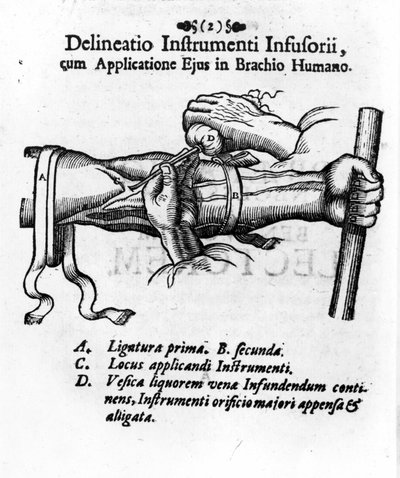 Iniezione endovenosa usando una vescica per clisteri. di J. D. Mayor, “Surgery Infusoria”, Kilonii 1667 da Unknown artist