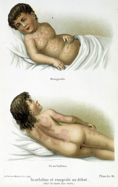 Scarlattina e morbillo - XIX secolo da Unknown artist