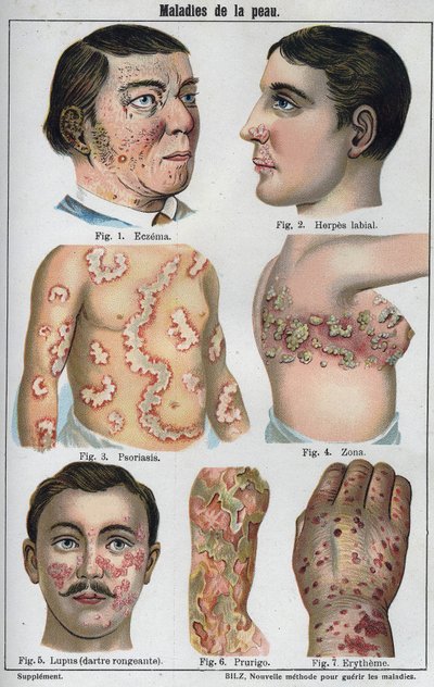 Malattie della pelle: Eczema, herpes labiale, psoriasi, fuoco di Sant