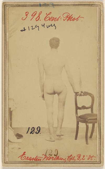 Frattura del terzo superiore del femore. Erastus Worthen, Corpo Co. B. 2nd Vermont Vols. 25 anni - Residenza Stockbridge VT. da Unknown artist