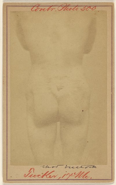 [Jno. E. Tucker, colpito da una pallottola nelle natiche, vittima della guerra civile]. da Unknown artist