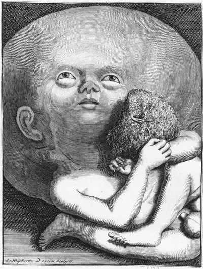 Mostro: Bambino idrocefalo antropologia - grav., fine XVIII secolo da Unknown artist