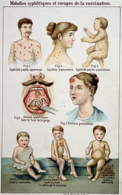 Tavola illustrativa delle diverse forme di malattie sifilitiche e dei pericoli della vaccinazione - in "Bilz, Natural Medication", fine XIX secolo da Unknown artist