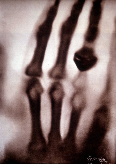 Raggi Roentgen o raggi X Prima fotografia: la mano della moglie di Roentgen. 22/12/1895. da Unknown artist