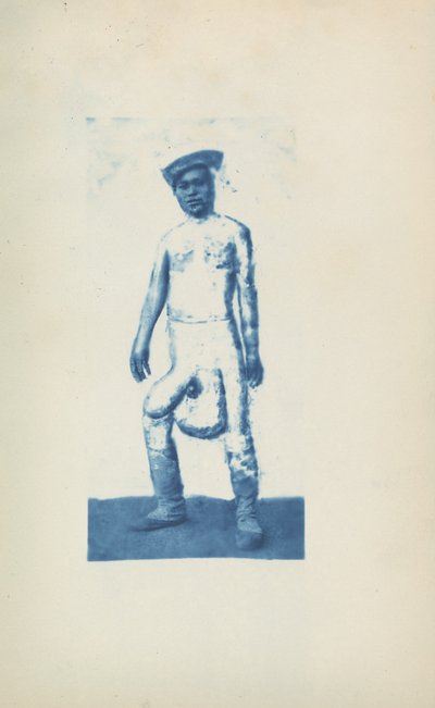 Elefantiasi, c. 1870 (foto) da Unknown photographer