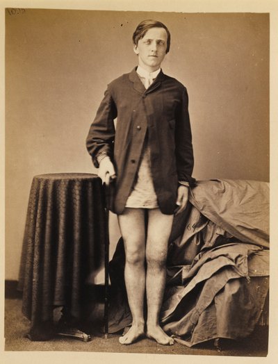 Soldato G. W. Warrington, guarigione senza amputazione dopo una frattura da arma da fuoco della rotula destra, dal catalogo fotografico della Sezione Chirurgica da William Bell