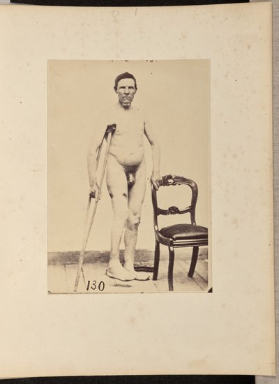 Frattura consolidata da arma da fuoco del terzo medio del femore destro da William H. Bell