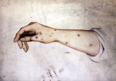 Studio di un avambraccio con condizione della pelle, c.1850 da William Lover