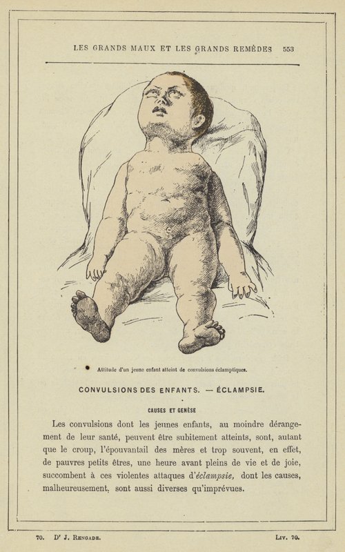 Atteggiamento di un bambino colpito da convulsioni eclamptiche da French School