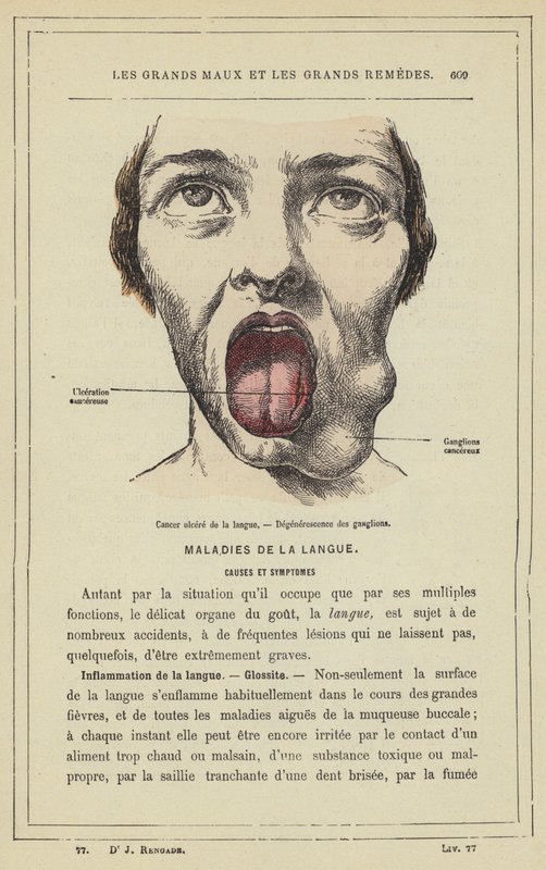 Cancro ulcerato della lingua, degenerazione dei gangli (litografia a colori) da French School