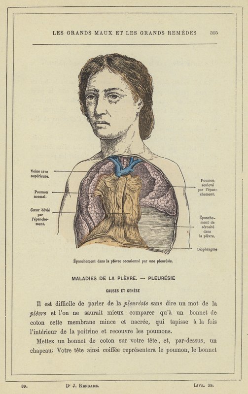 Versamento nella pleura causato da una pleurite da French School
