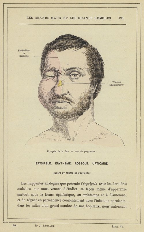 Erisipela del viso in via di progressione da French School