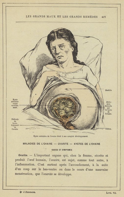 Cisti areolare dell