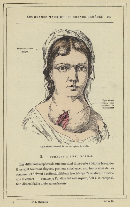 Cisti sierosa compartimentata del collo, lipoma della testa (litografia a colori) da French School