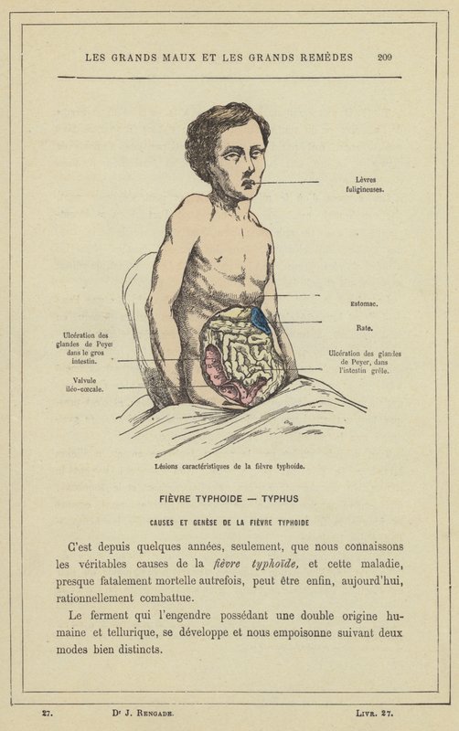 Lesioni caratteristiche della febbre tifoide (litografia a colori) da French School