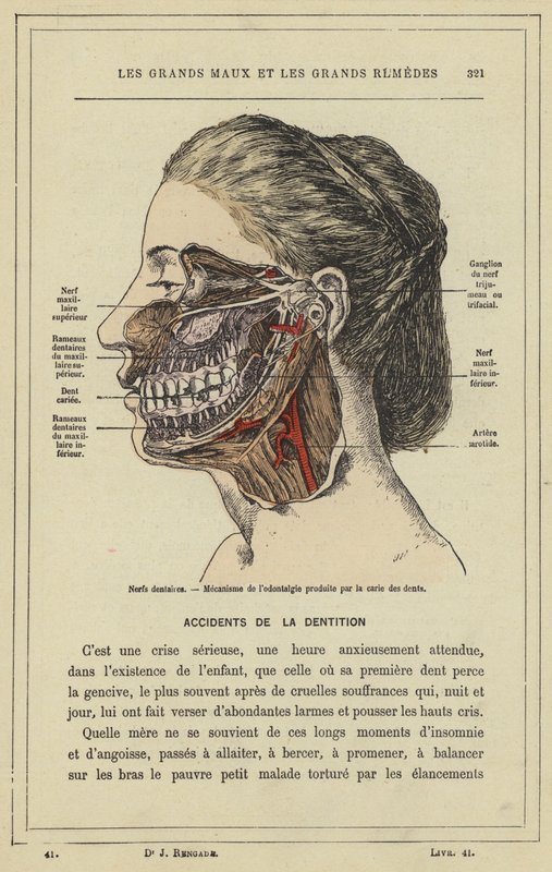 Nervi dentali, meccanismo del mal di denti causato dalla carie (litografia a colori) da French School