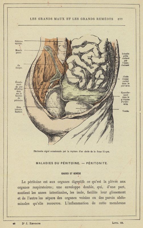 Peritonite acuta causata dalla rottura di un ascesso della fossa iliaca da French School