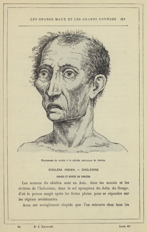 Fisionomia del malato nel periodo asfittico del colera da French School