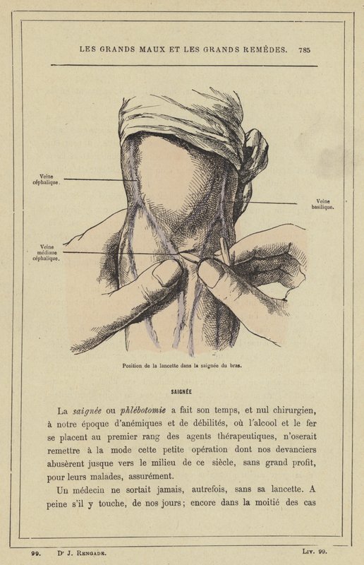 Posizione della lancetta nella salasso del braccio (litografia a colori) da French School