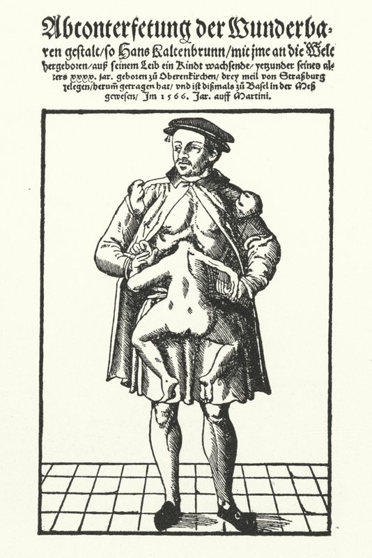 Hans Kaltenbrunn e il suo gemello congiunto non sviluppato da German School