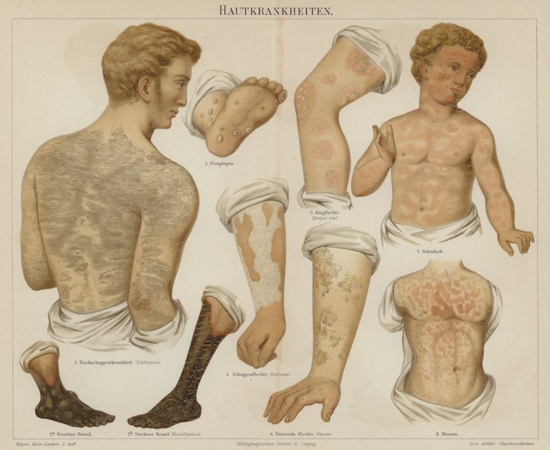 Disturbi della pelle da German School