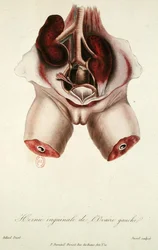 Ernia inguinale dell