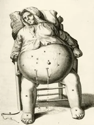 Drenaggio di liquidi da un ascesso, da Exercitationes Practicae circa Medendi Methodum di Frederik Dekkers, 1694