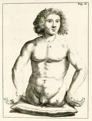 Esempio di difetti congeniti, da Exercitationes Practicae circa Medendi Methodum di Frederik Dekkers, 1694