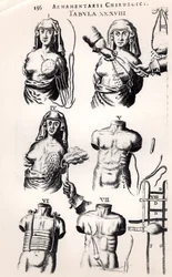 Operazione per il cancro al seno, da Armamentarii Chirurgici di Johannes Schultes pubblicato ad Amsterdam, 1672