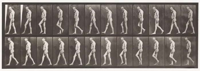 Tavola 555. Atrofia muscolare delle gambe; adulto, A,B, camminare, 1885