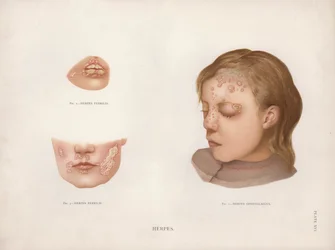 Malattie della Pelle: Herpes