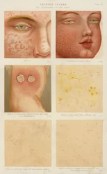 Febbri eruttive (litografia a colori)