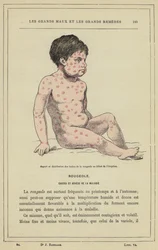 Aspetto e distribuzione delle macchie del morbillo all