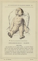 Atteggiamento di un bambino colpito da convulsioni eclamptiche