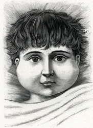 Bambino con parotite (incisione)