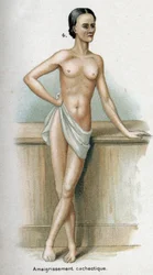 Ritratto di donna con perdita di peso cachettica (stampa)